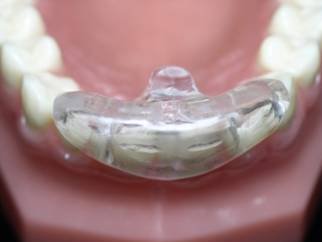 INVISALIGN-1